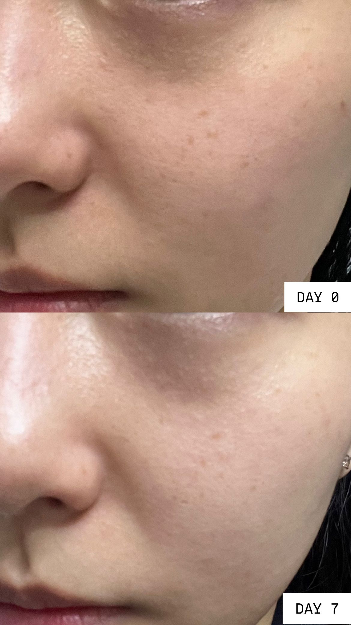 AHC 醫美科妍水光導入玻尿酸精華 真實評價/實測照片 byB***s 1