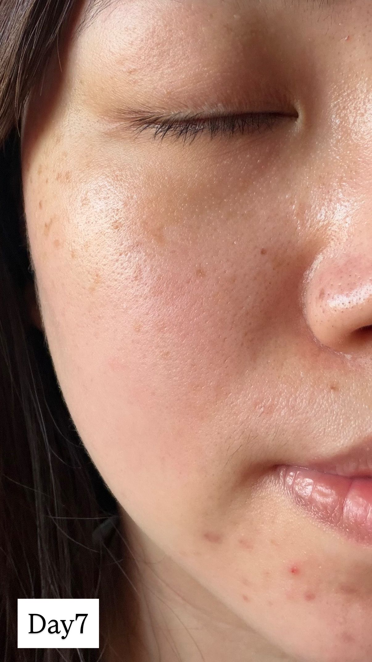 AHC 醫美科妍水光導入玻尿酸精華 真實評價/實測照片 bybel****************com 3