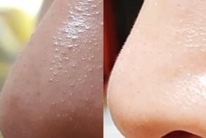 Ilso 黑頭粉刺導出液 真實評價/用後感 byman***************com 1 Ilso 黑頭粉刺導出液 真實評價/實測照片 byman***************com 1