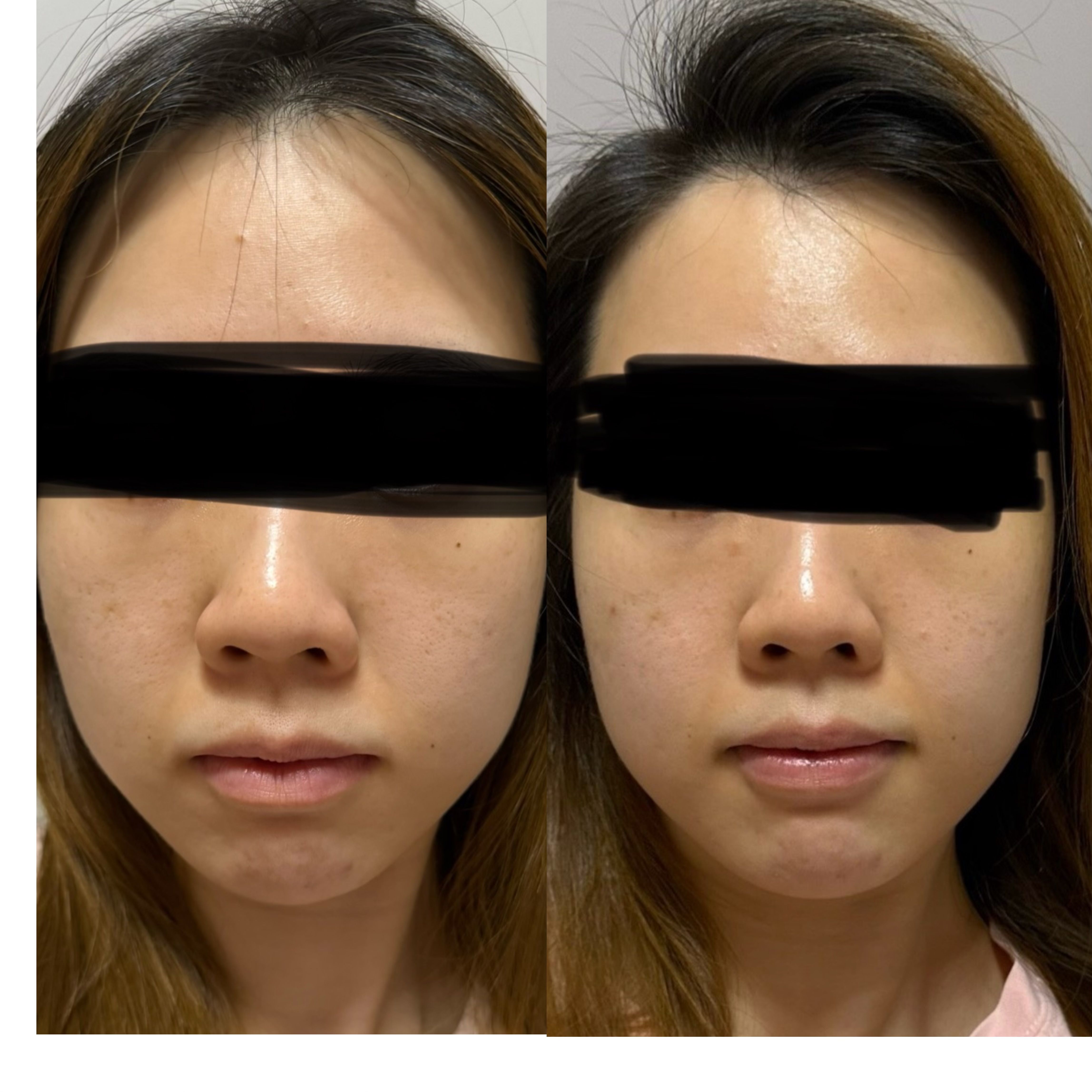 Skin Need 04G 抗醣抗氧阿魏酸BCE精華 真實評價/實測照片 byEu**** H 1