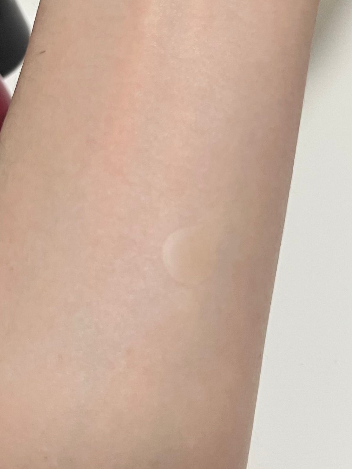 3M 神無瑕荳痘貼綜合型 真實評價/實測照片 byMsg***ros 1