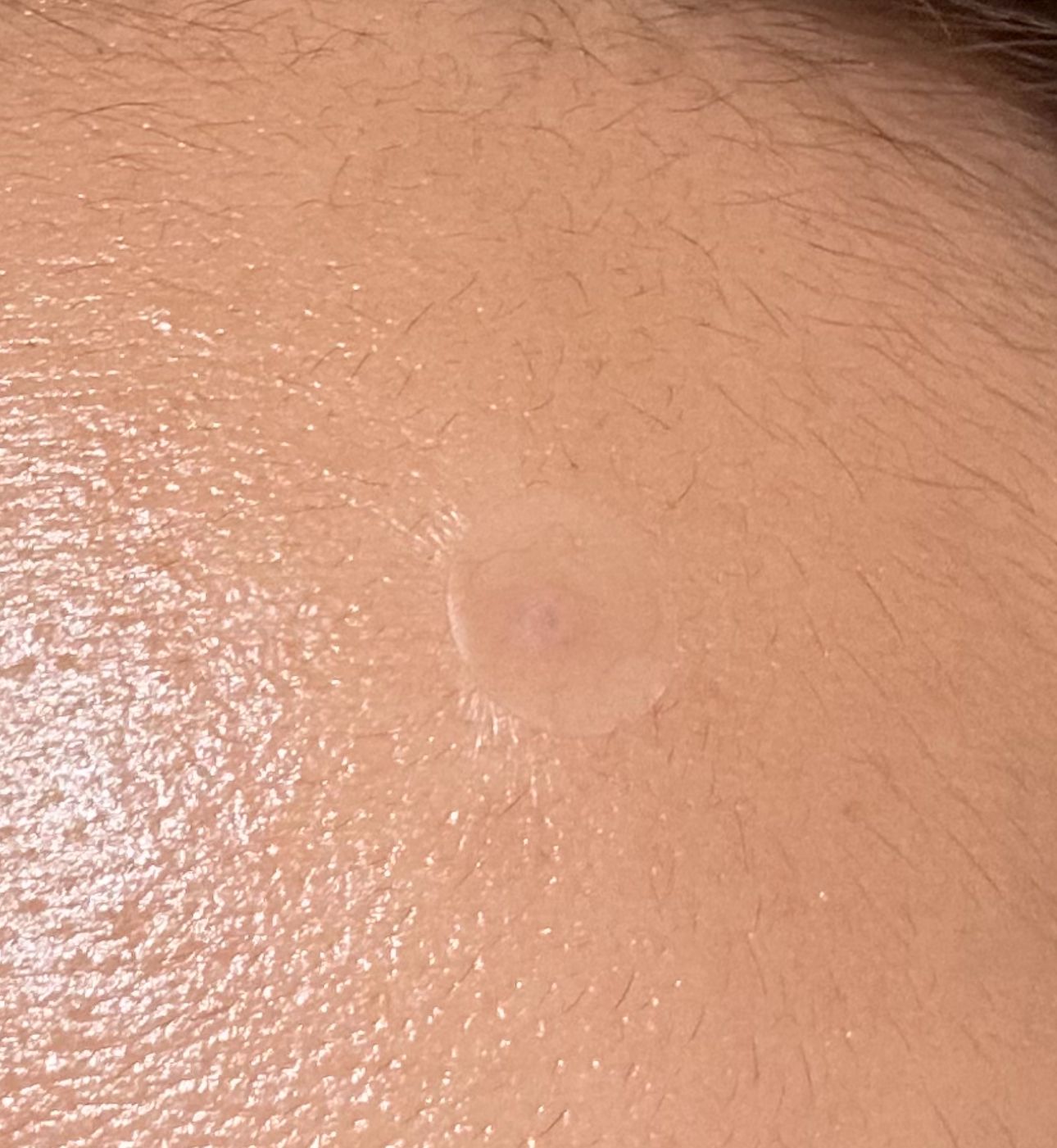 曼秀雷敦 Mentholatum 樂膚潔抗菌痘痘貼 (日夜高效型) 真實評價/實測照片 bysel*************com 1