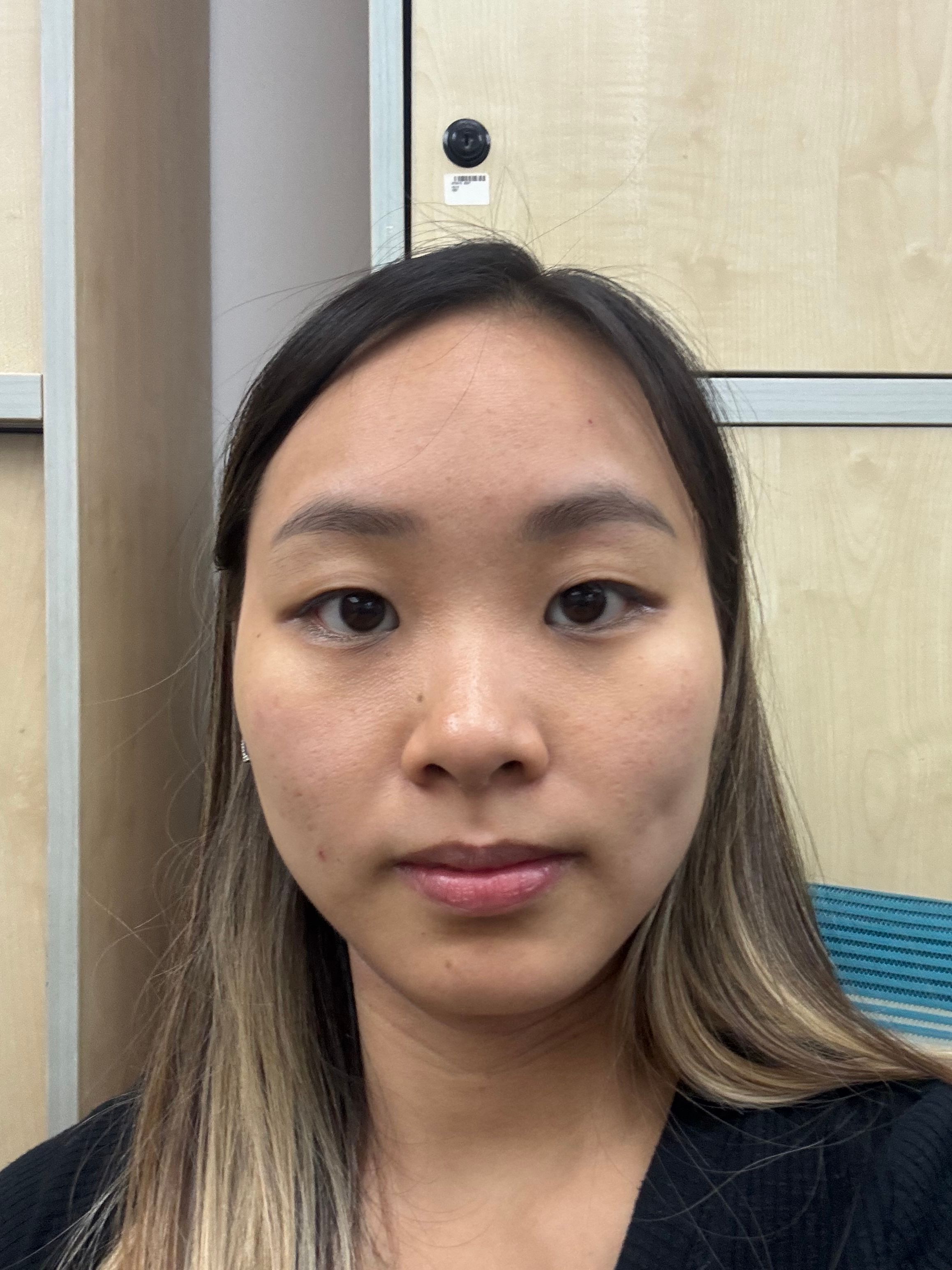 Benzac 克痘靈 3 重功效痘痘貼 真實評價/實測照片 bymei***************com 1