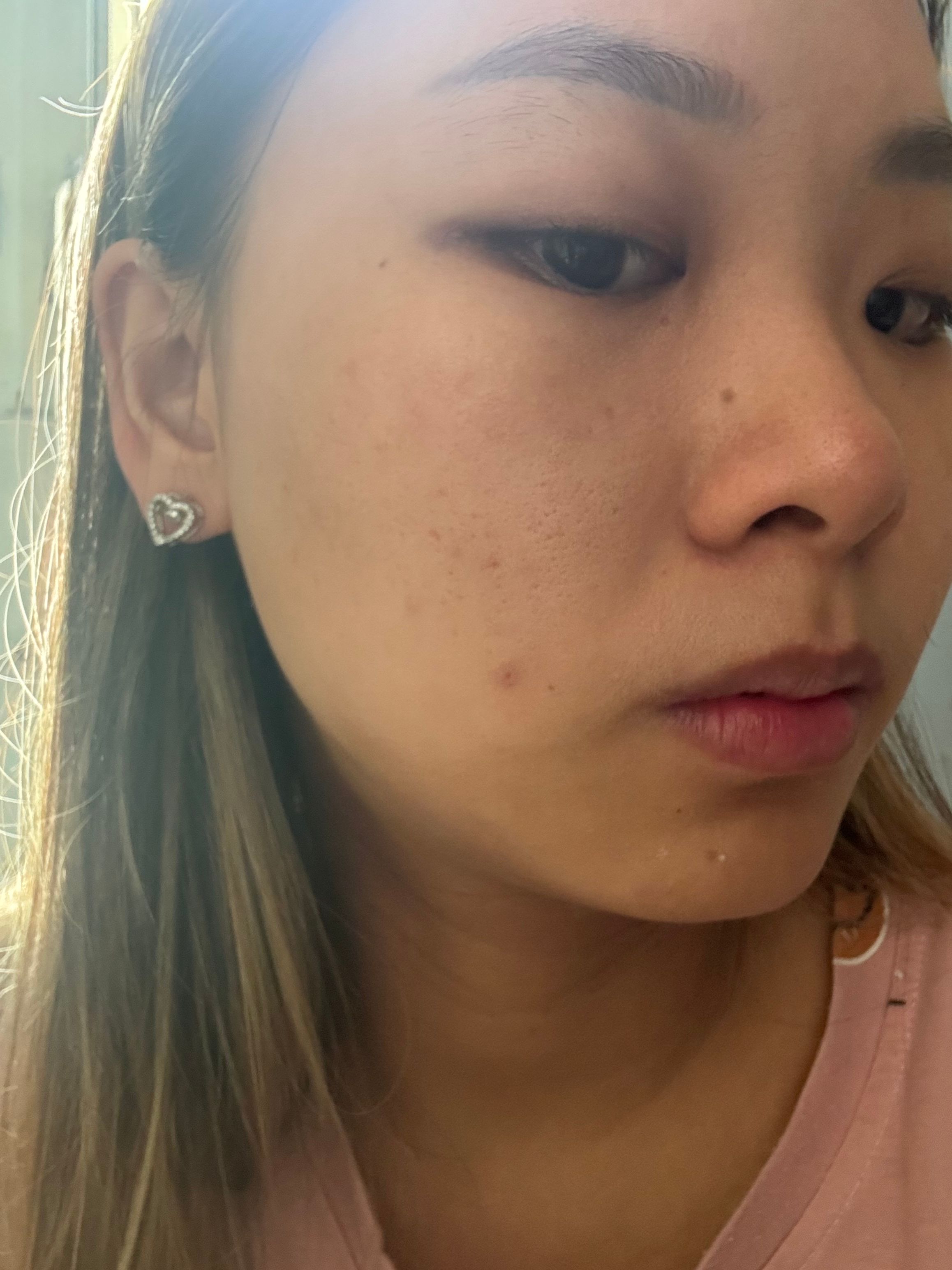 Benzac 克痘靈 3 重功效痘痘貼 真實評價/實測照片 bymei***************com 2