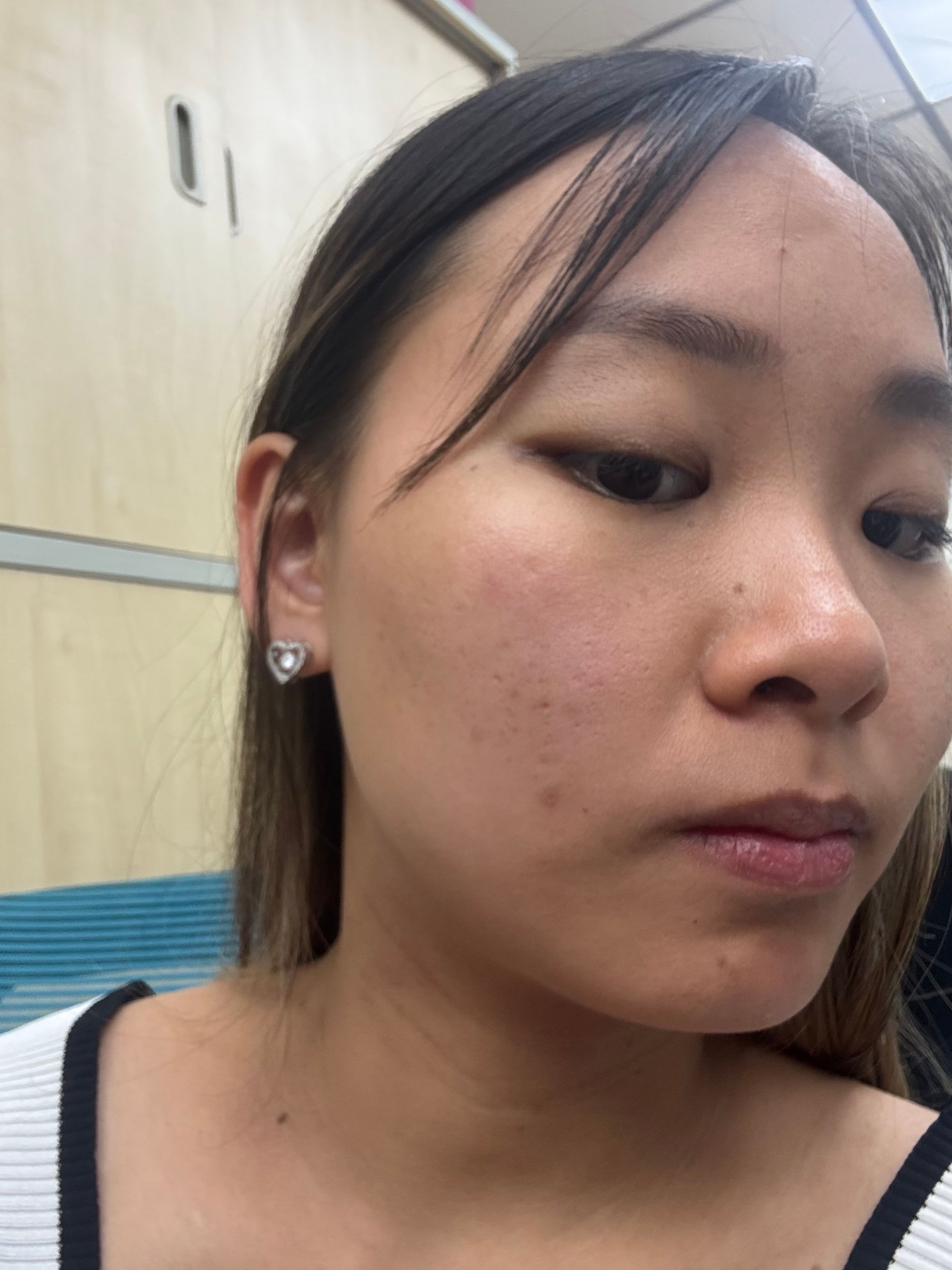 Benzac 克痘靈 3 重功效痘痘貼 真實評價/實測照片 bymei***************com 3