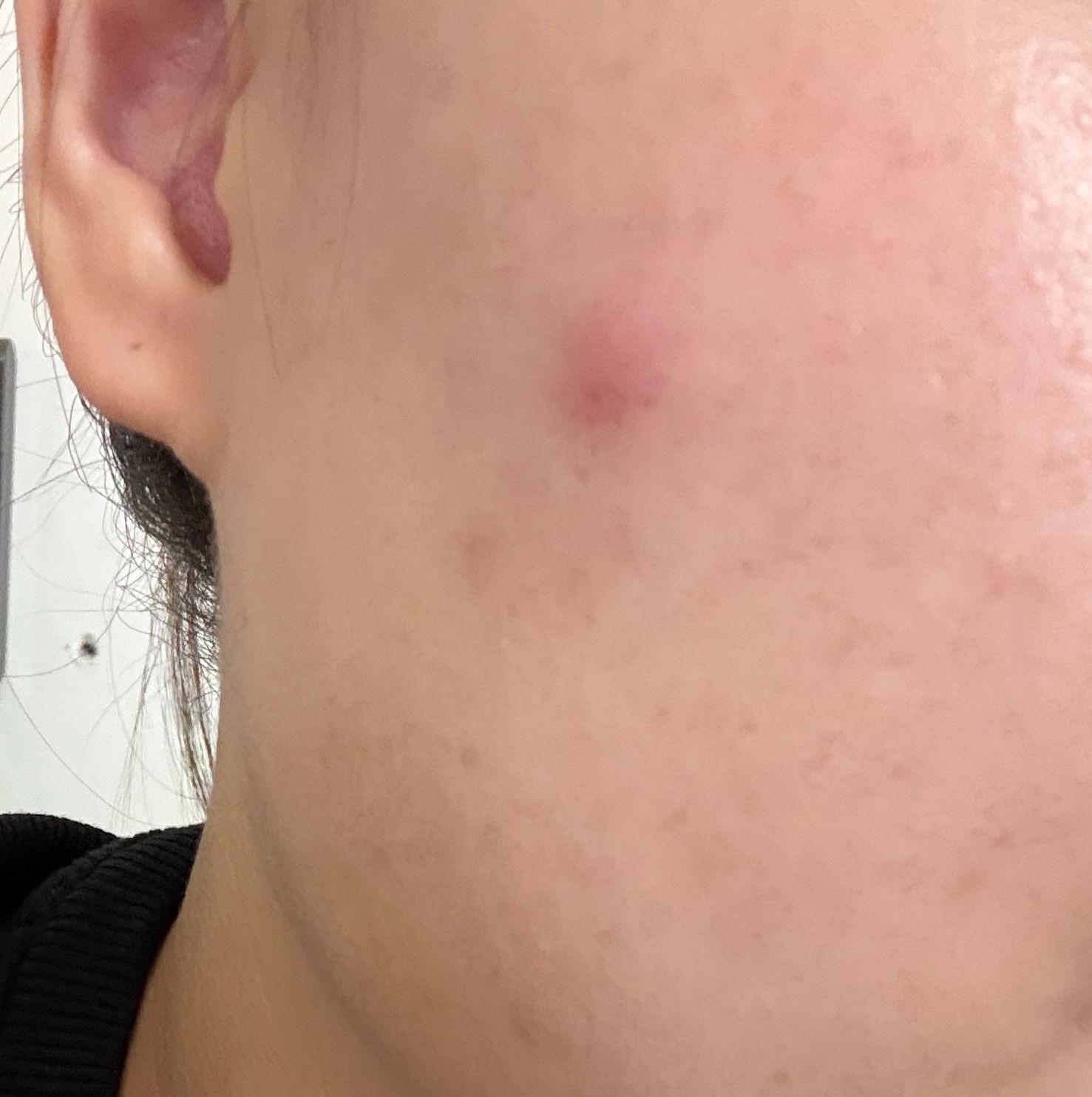 Benzac 克痘靈 3 重功效痘痘貼 真實評價/實測照片 byYa**an 1