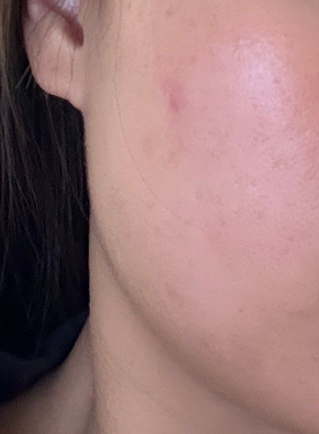 Benzac 克痘靈 3 重功效痘痘貼 真實評價/實測照片 byYa**an 2