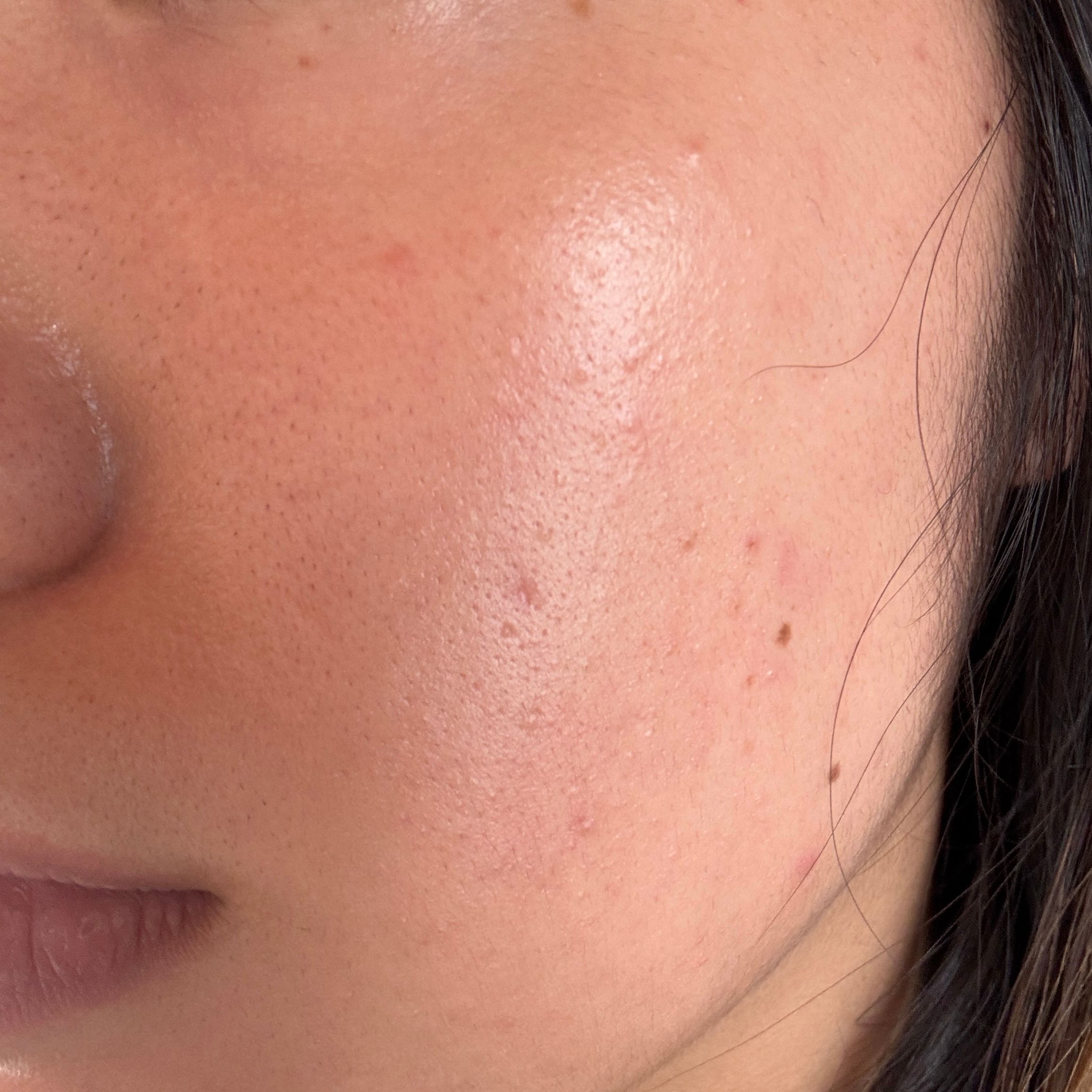 The Ordinary 甘醇酸7%爽膚水 真實評價/實測照片 byCai******han 1