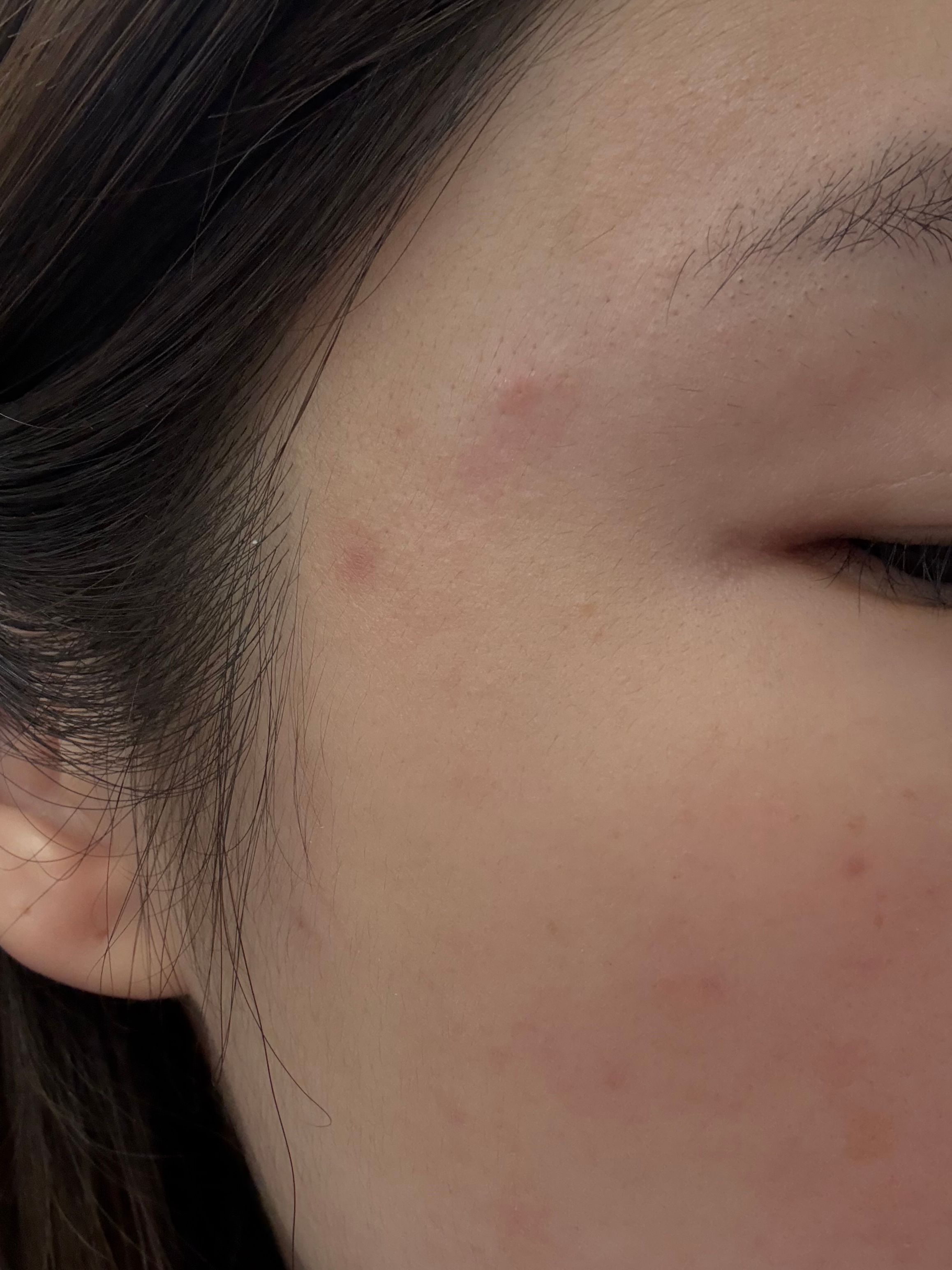 Benzac 克痘靈 3 重功效痘痘貼 真實評價/實測照片 byyub*************com 2