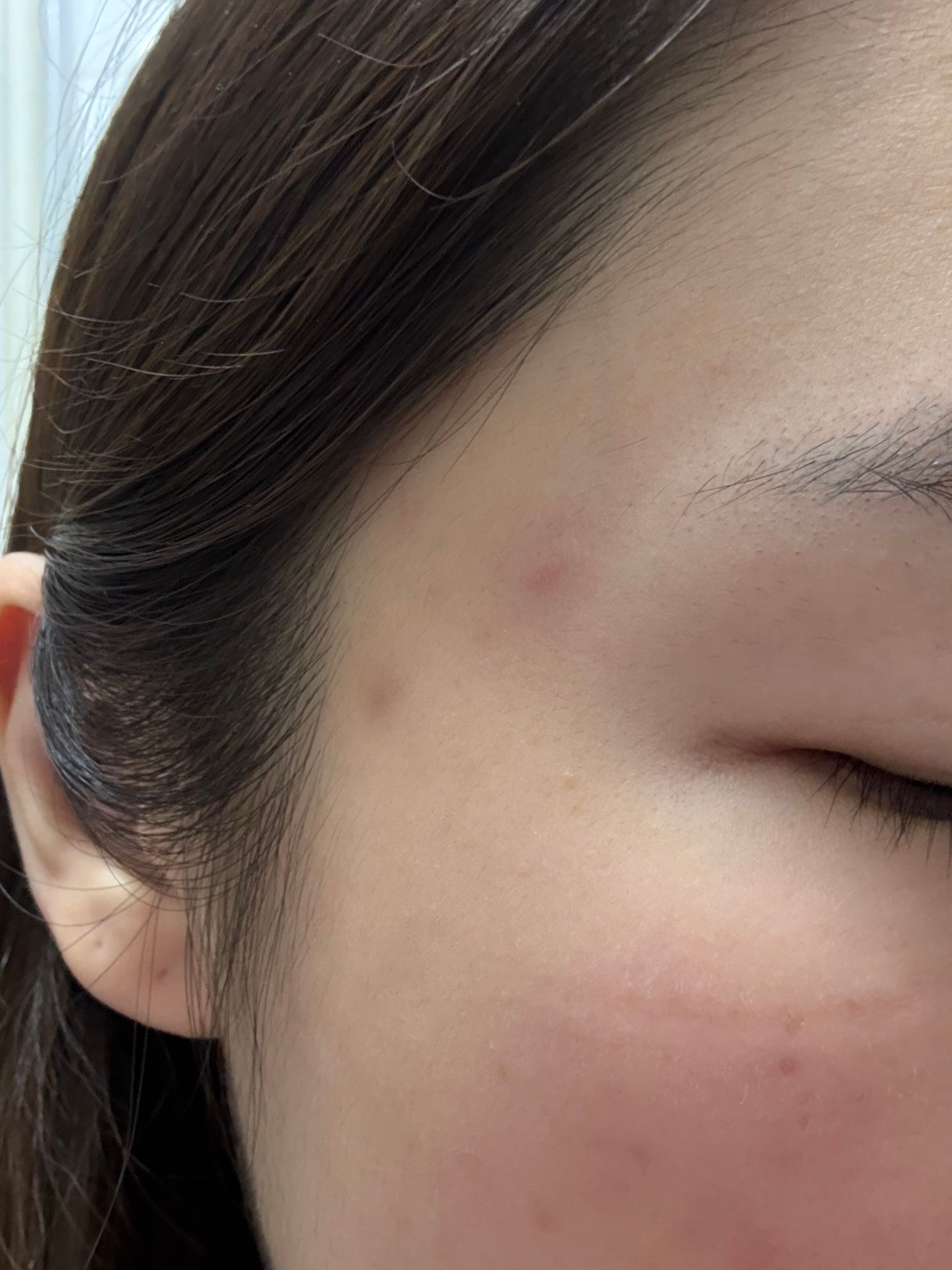 Benzac 克痘靈 3 重功效痘痘貼 真實評價/實測照片 byyub*************com 1