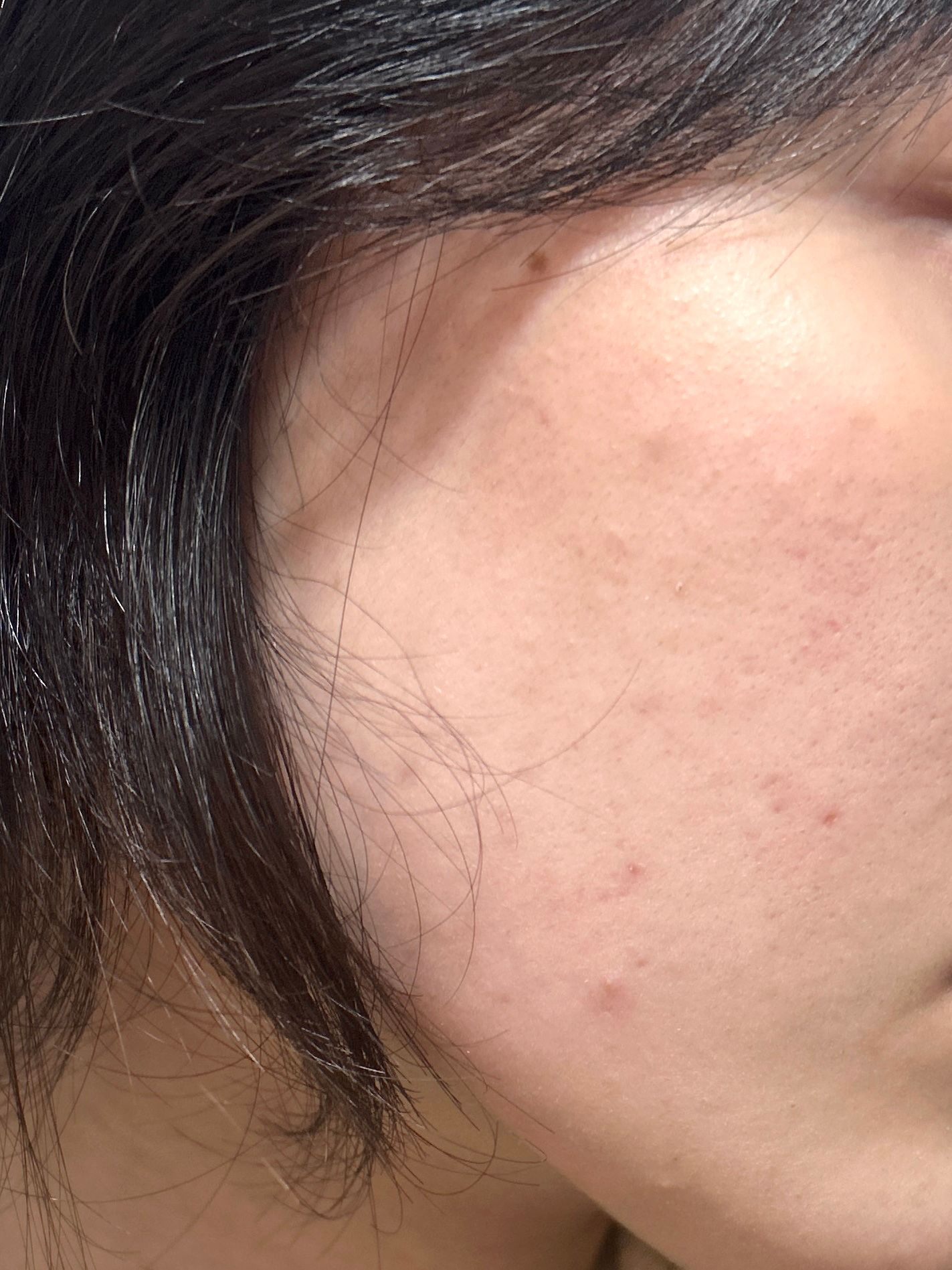 Benzac 克痘靈 3 重功效痘痘貼 真實評價/實測照片 bymo***oi 2