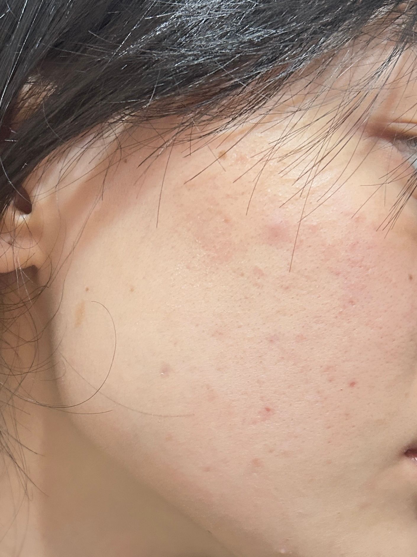 Benzac 克痘靈 3 重功效痘痘貼 真實評價/實測照片 bymo***oi 1