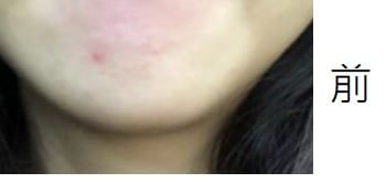 Benzac 克痘靈 3 重功效痘痘貼 真實評價/用後感 byLu***NG 2 Benzac 克痘靈 3 重功效痘痘貼 真實評價/實測照片 byLu***NG 2