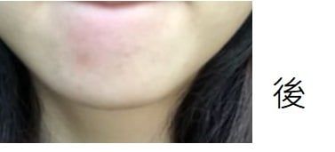 Benzac 克痘靈 3 重功效痘痘貼 真實評價/用後感 byLu***NG 1 Benzac 克痘靈 3 重功效痘痘貼 真實評價/實測照片 byLu***NG 1
