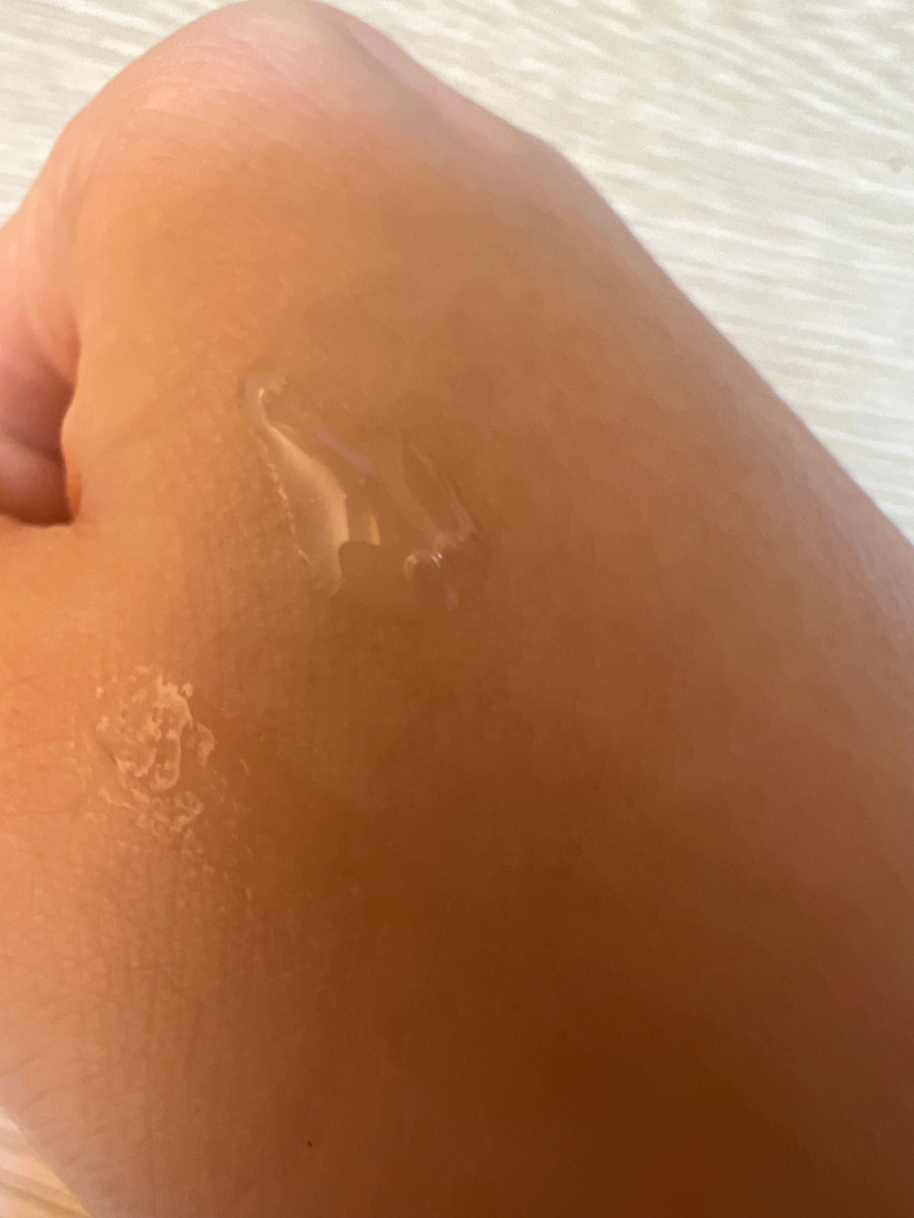 Galderma 維他命A酸祛痘暗瘡 真實評價/實測照片 bye*f 1