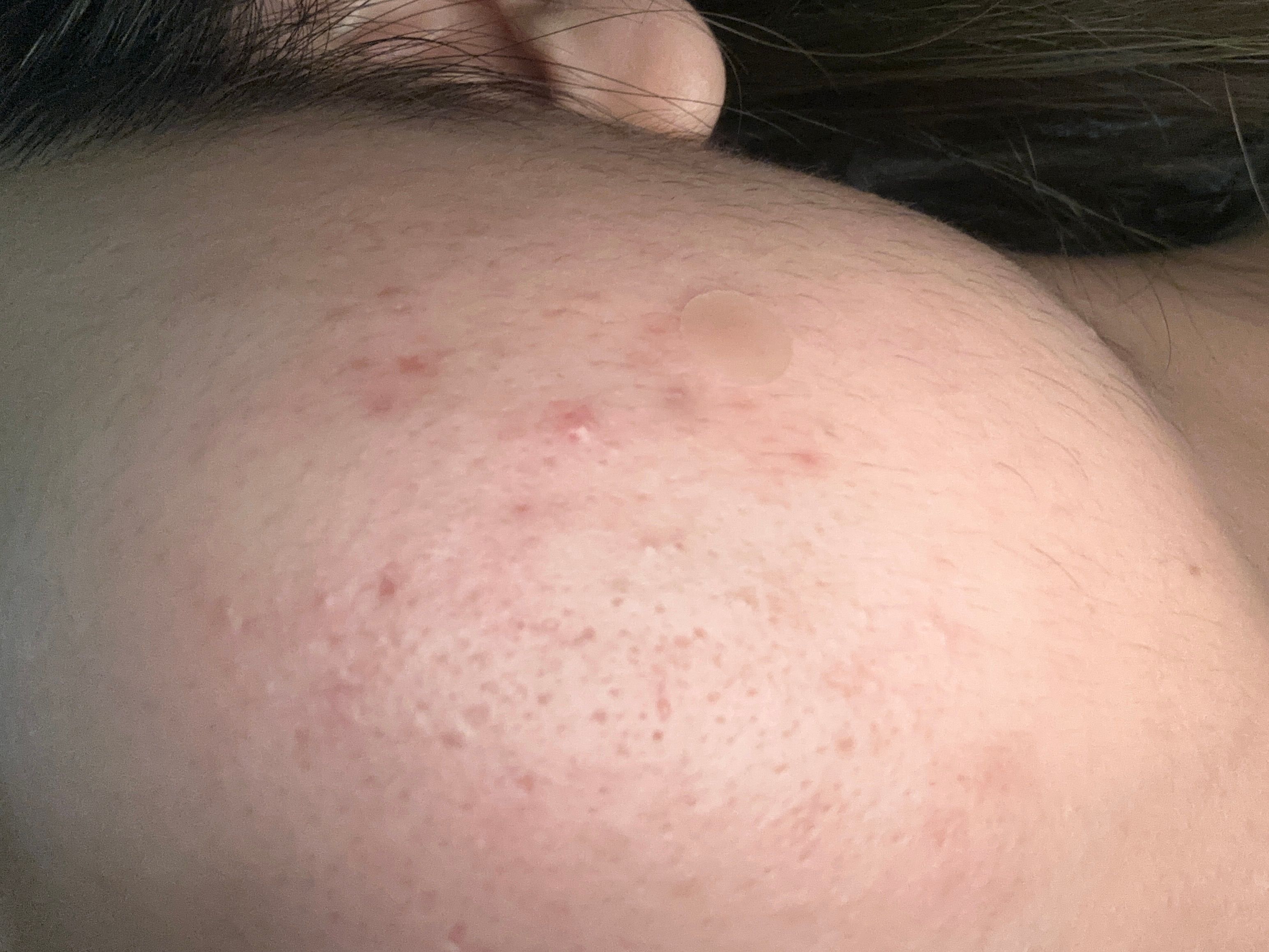 曼秀雷敦 Mentholatum 樂膚潔抗菌痘痘貼 真實評價/實測照片 by 1