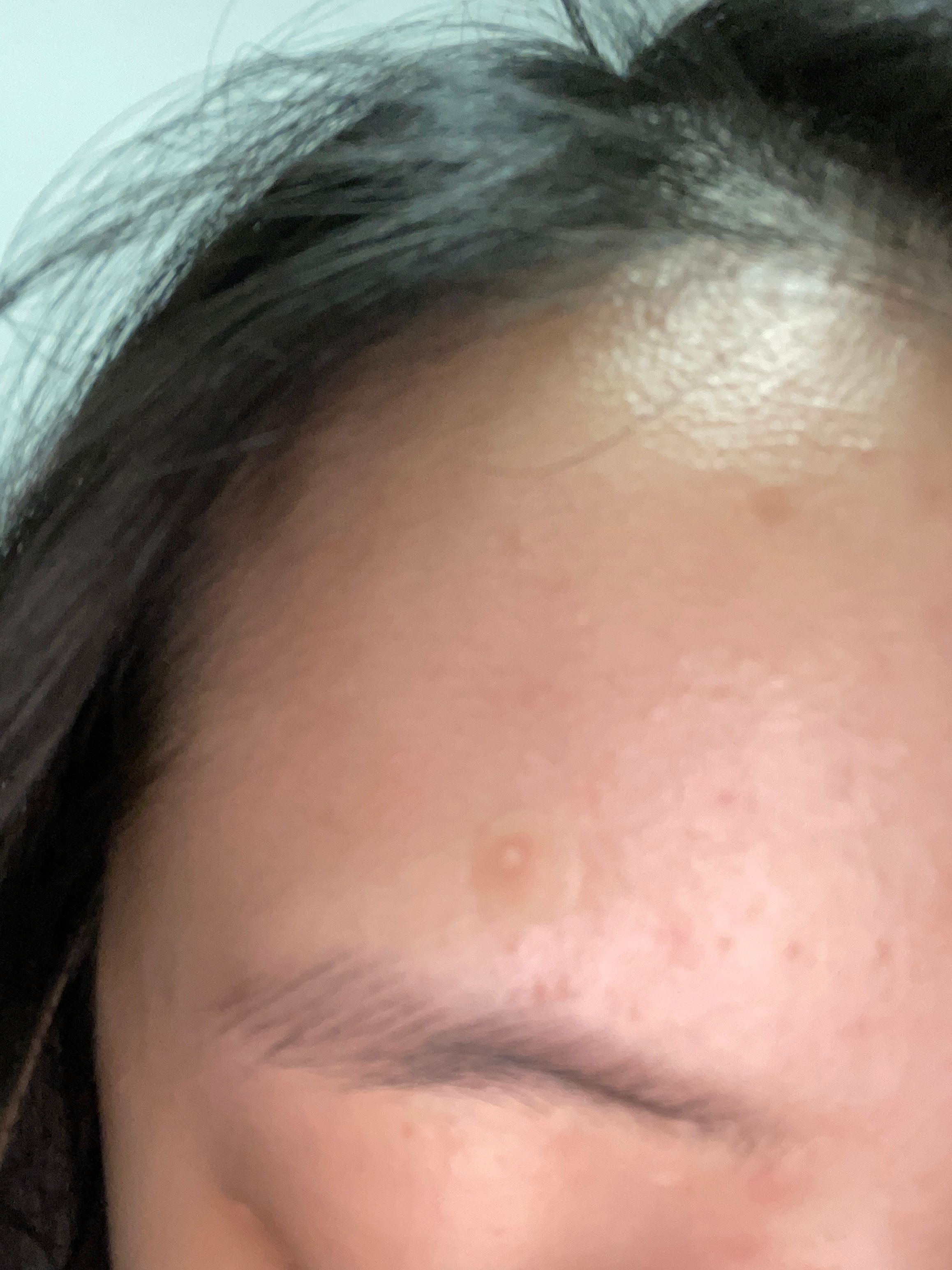 曼秀雷敦 Mentholatum 樂膚潔抗菌痘痘貼 (日夜高效型) 真實評價/實測照片 byB***e 1