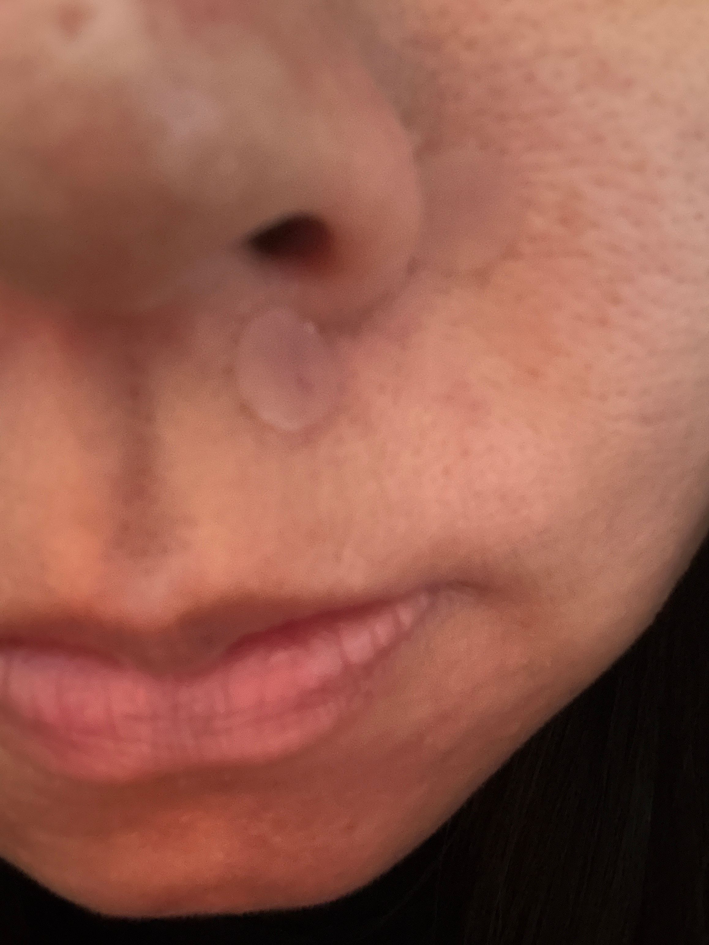 曼秀雷敦 Mentholatum 樂膚潔抗菌痘痘貼 真實評價/用後感 bydor***************com 1 曼秀雷敦 Mentholatum 樂膚潔抗菌痘痘貼 真實評價/實測照片 bydor***************com 1