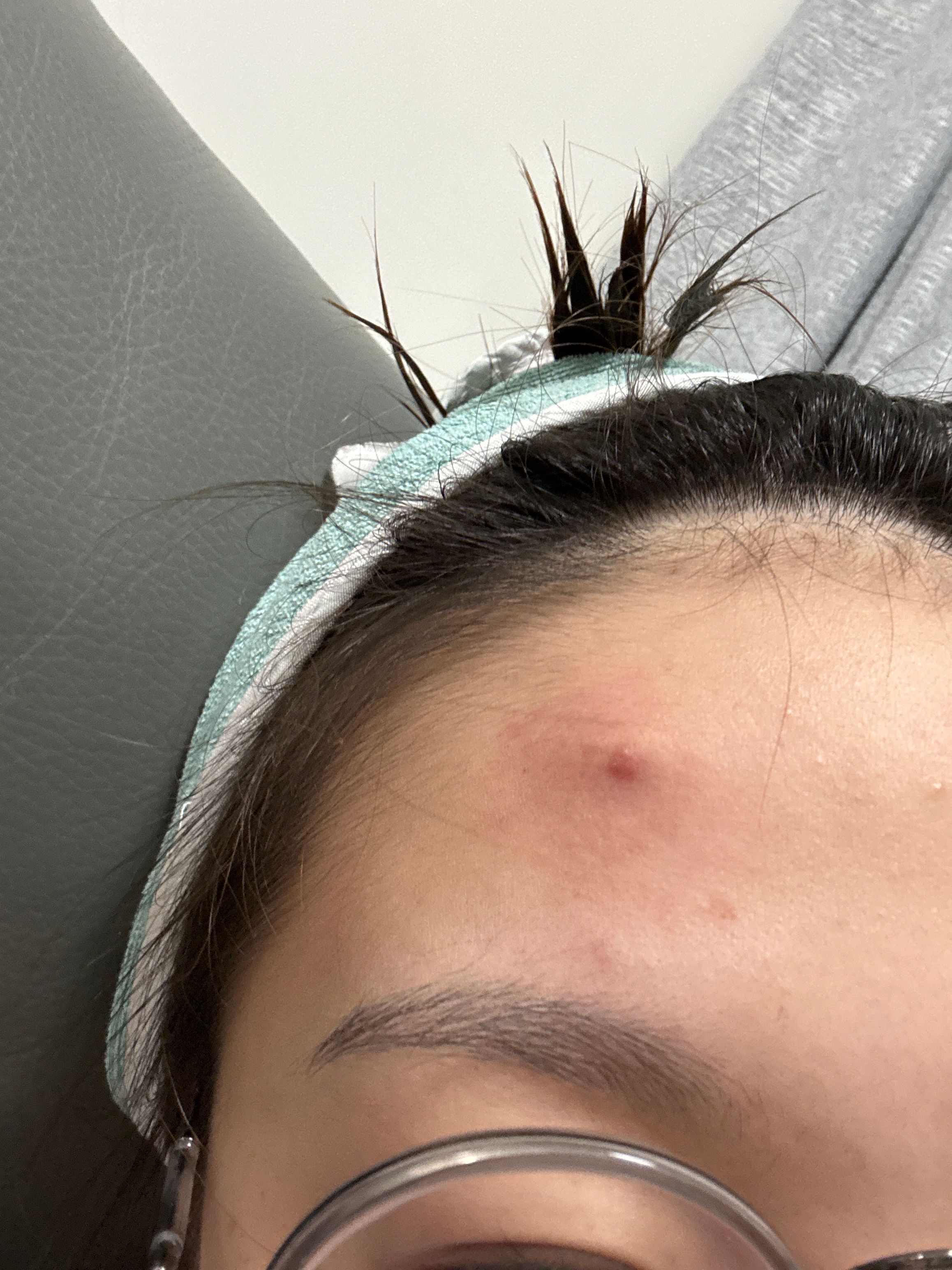 曼秀雷敦 Mentholatum 曼秀雷敦Acnes痘痘貼-隱透型 真實評價/實測照片 byLee***321 1