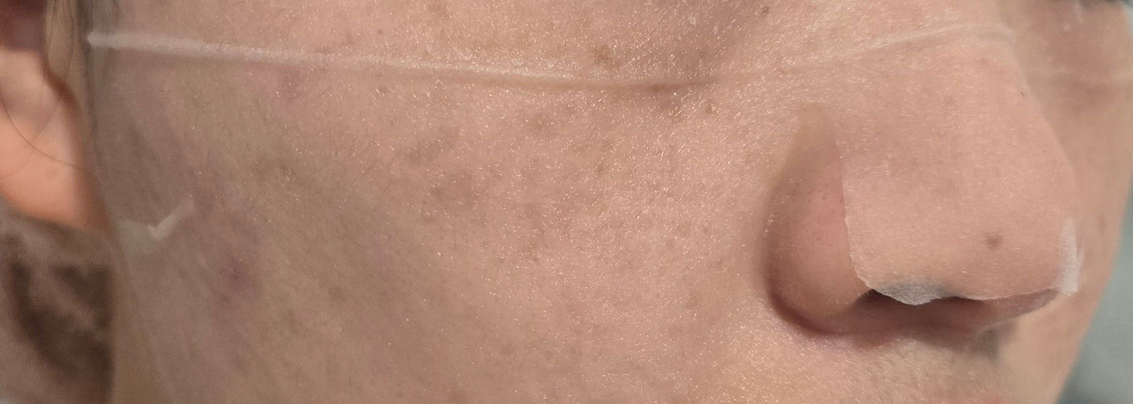 Bring Green 茶樹積雪草袪痘修護面膜 真實評價/實測照片 byEd**Be 2